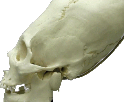 elongated skull