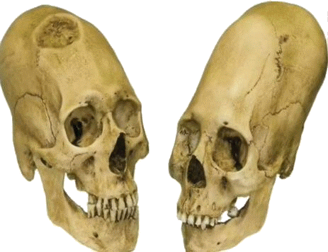 elongated skull